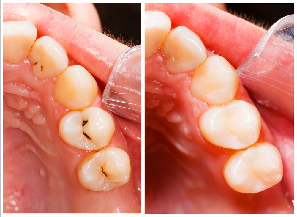 Closeup of Composite Tooth-Colored Fillings