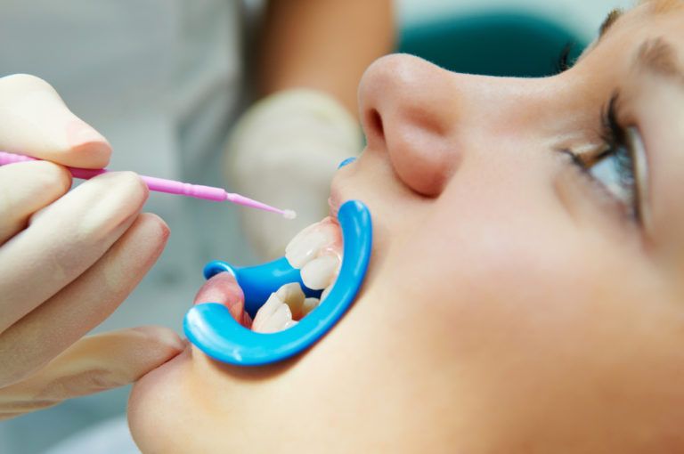 Dental Sealants - woman with open mouth during dental procedure