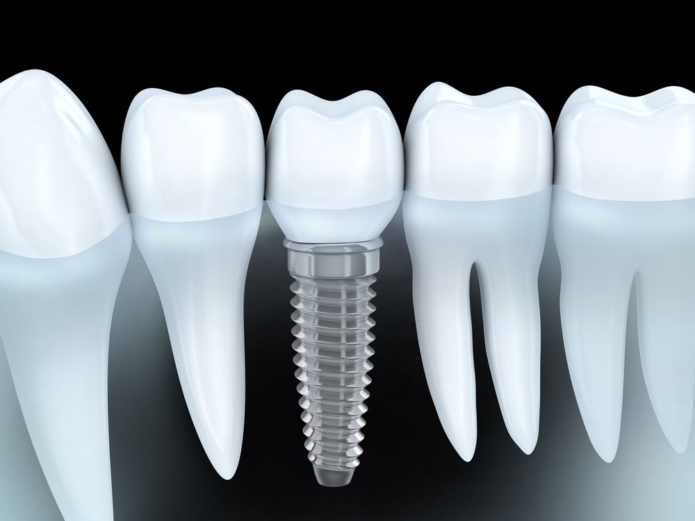 Tooth human implant (3d graphics)