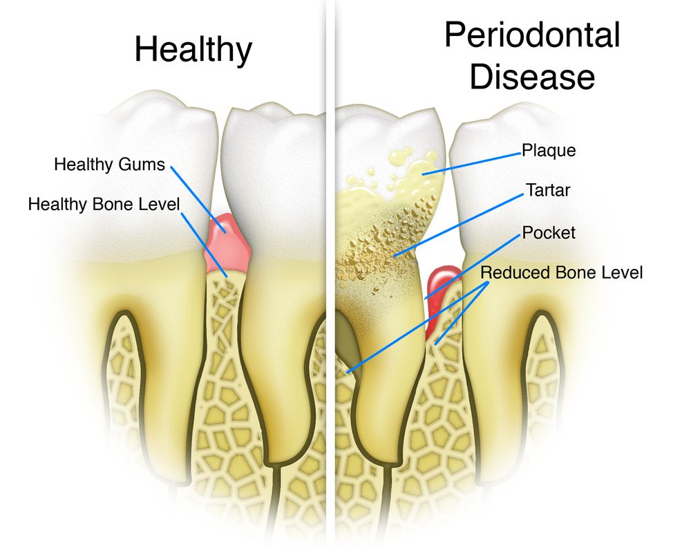Periodontal Disease Detail