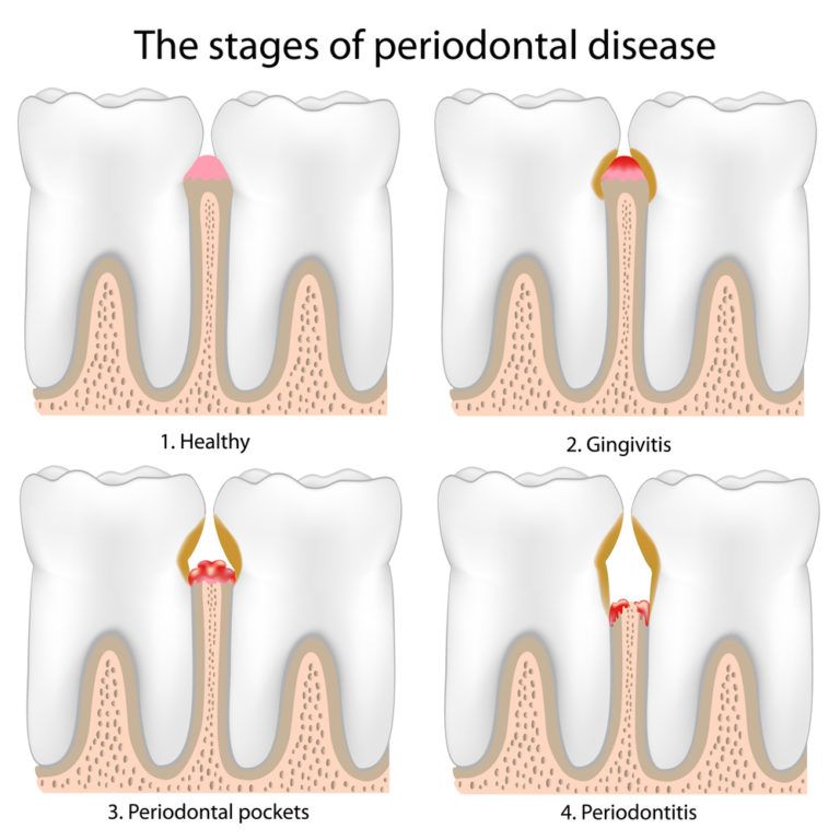 Signs and Symptoms of Periodontal Disease