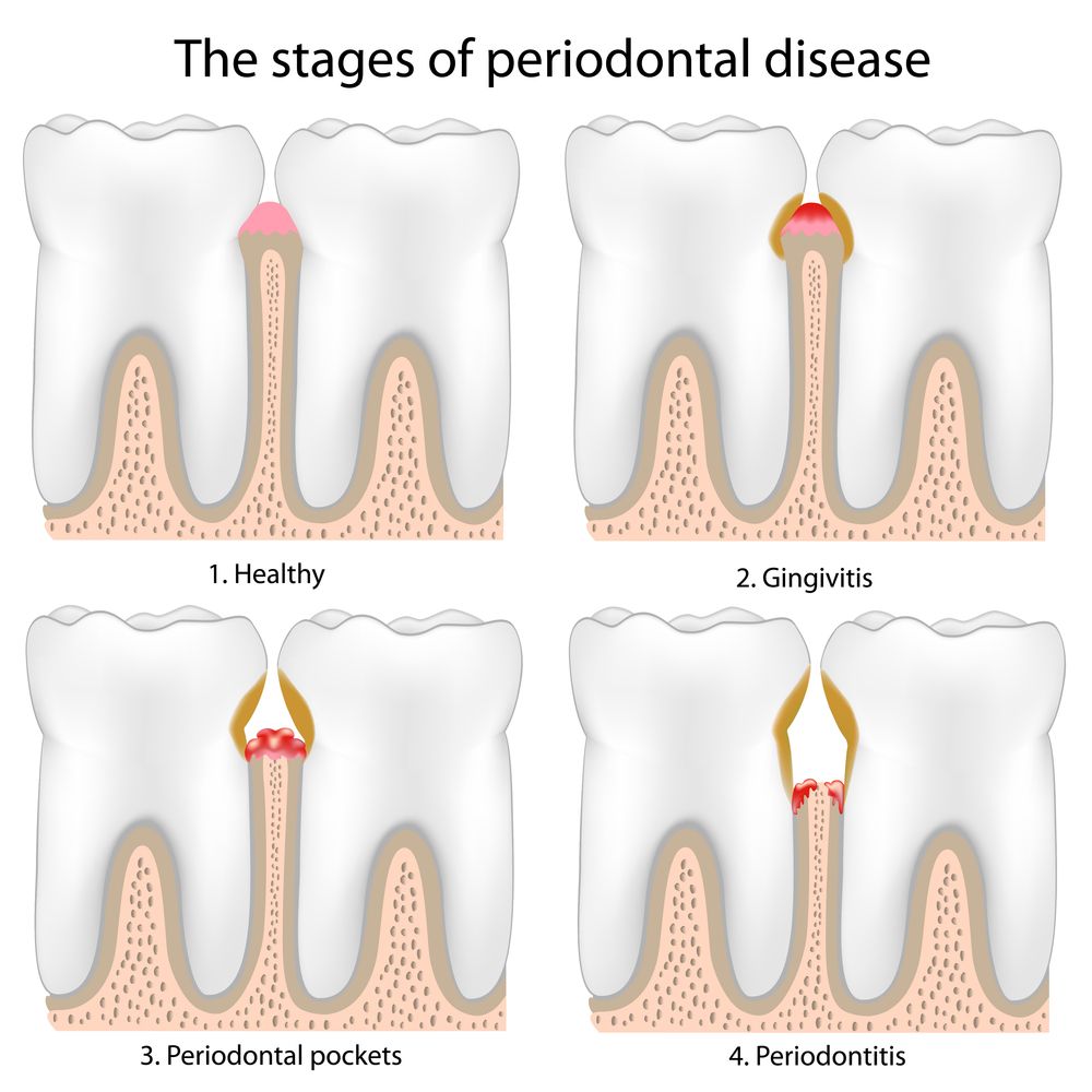 what-are-the-causes-and-treatment-for-periodontal-disease